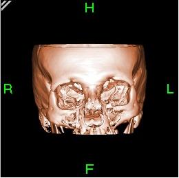 Bone reconstructed in 3D