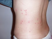 Flea bites on the back of a human