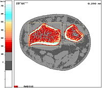 pQCT-measurement at distal radius (cross-sectional image)