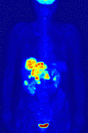 Maximum intensity projection (MIP) of a typical F-18 FDG wholebody PET acquisition