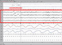 EEG showing brainwaves during REM sleep