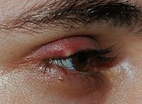 The stye is a common irritating inflammation of the eye.