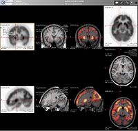 A Brain PET / MRI Fusion image