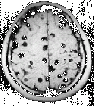 Neurocysticercosis Images