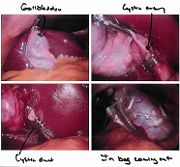 Cholecystectomy seen through a laparoscope