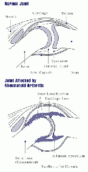 Joint abnormalities in rheumatoid arthritis