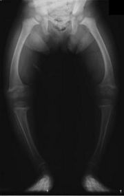 Radiograph of a two-year old rickets sufferer, with a marked genu varus (bowing of the femurs) and decreased bone opacity, suggesting poor bone mineralization.