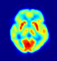 PET scan of the human brain.