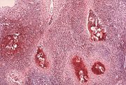 Photomicrography of bladder in S. hematobium infection, showing clusters of the parasite eggs with intense eosinophilia, Source: CDC