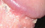 The control of smegma is often cited as a justification of circumcision