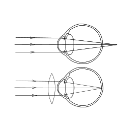 Hyperopia, and restoring of vision with convex lens