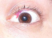 A subconjunctival hemorrhage is a common and relatively minor post-LASIK complication.
